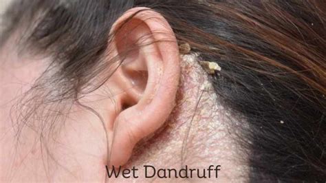 Does Dandruff Cause Acne Relationship And Treatment