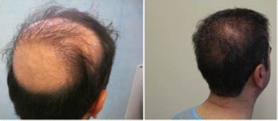 Crown Hair Restoration