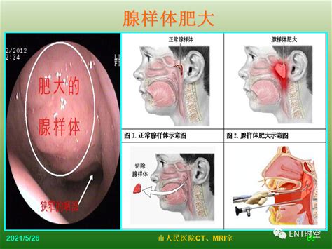 儿童腺样体肥大影像表现、诊断标准医学界 助力医生临床决策和职业成长