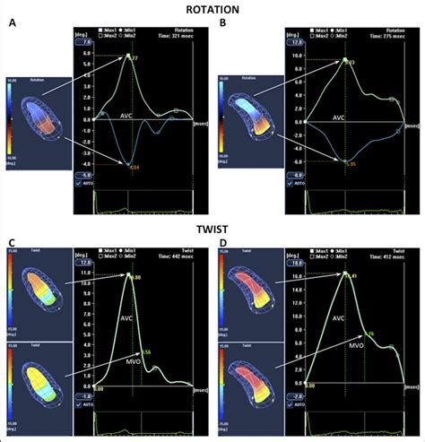 Figure 1 From Left Ventricular Twist Mechanics In Hypertrophic