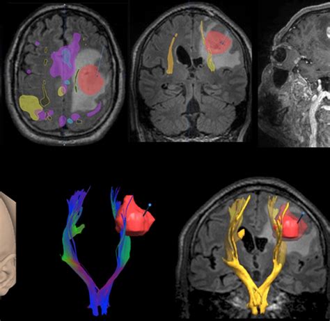 How Liquid Biopsy Could Improve Brain Tumor Treatment And Diagnoses