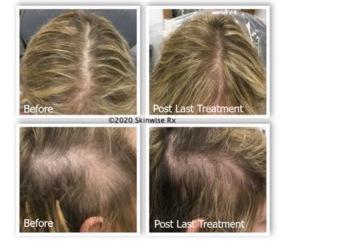 Female Hair Loss Aesthetic And Dermatology Center