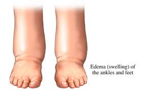 Oedema - Introduction to Oedema