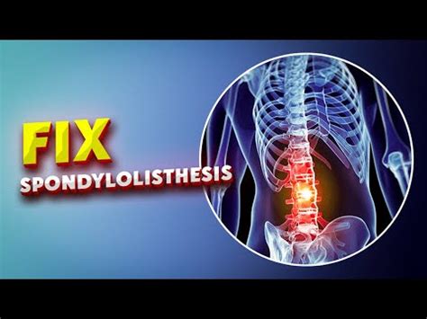 6 Easy Lumbar Spondylolisthesis Exercises to Correct Anterolisthesis and Related Low Back Pain