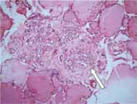 Hande Of Photomicrograph 100x Of Prophylactic Thyroidectomy Of