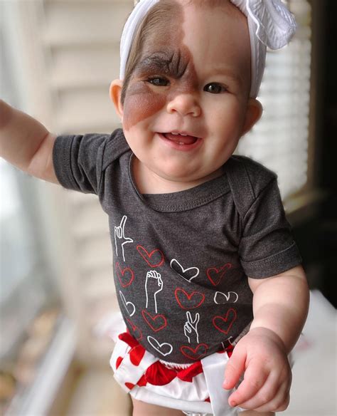 Une Maman Affiche La Beaut De Sa Fille N E Avec Une Tache De