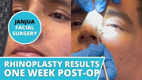 Rhinoplasty Results One Week Post Op Dr Tanveer Janjua New