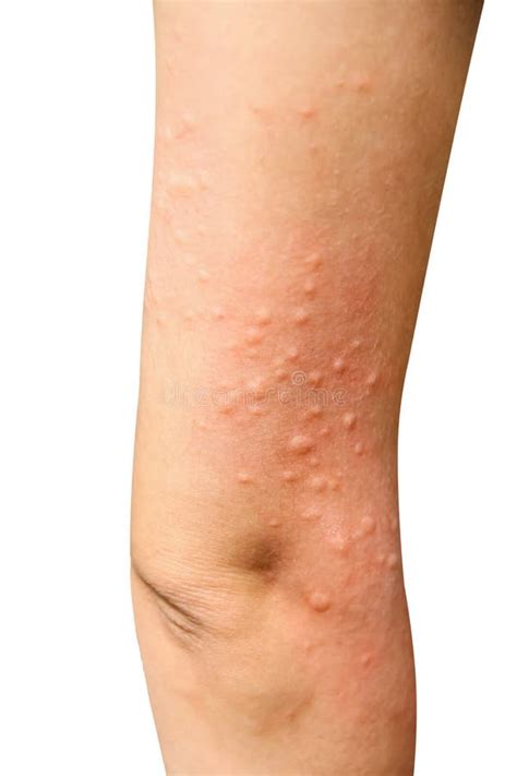 Shingles On Lower Leg