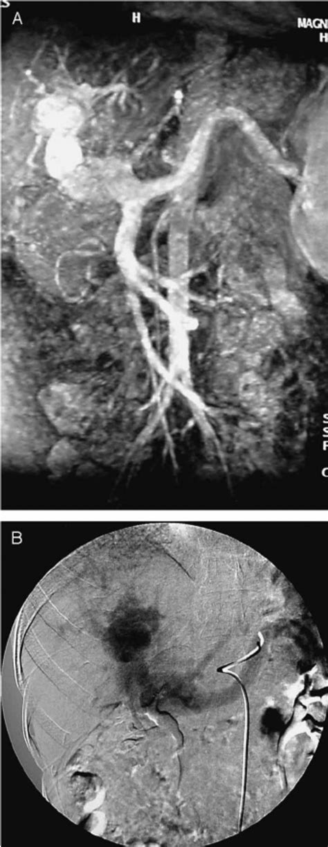 A And B Magnetic Resonance Angiography Mra Download Scientific Diagram