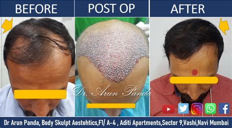 Finding The Right Hair Transplant Surgeon In Navi Mumbai