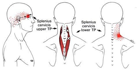 Splenius Capitis | The Trigger Point & Referred Pain Guide