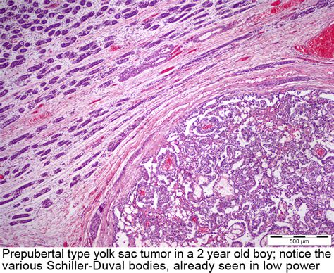 Pathology Outlines Yolk Sac Tumor