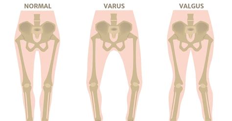 Il Ginocchio Valgo Sintomi Cause E Rimedi