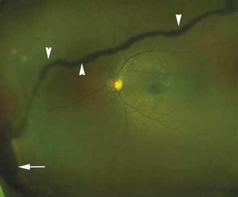 Retinal Dialysis | Ento Key