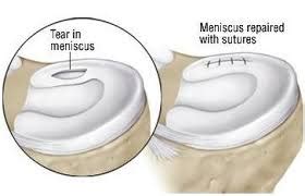 Sports and ACL Injuries: Meniscus Repair For Root Tears Is Most Economical