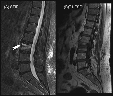 Differentiation Of Osteoporotic And Neoplastic Vertebral Fractures By