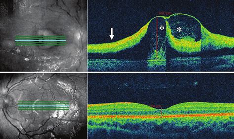 A Spectral Domain Optical Coherence Tomographic Sd Oct Raster Scan