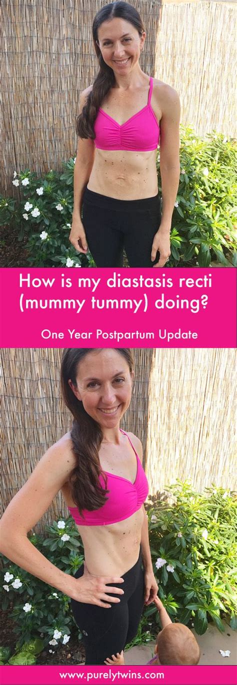 How To Fix Diastasis Recti Years Later Short Impressed