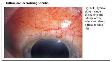 Scleritis