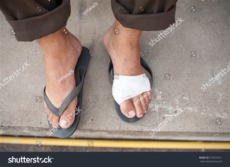 Foot Ulcers Stock Photo 273975671 | Shutterstock