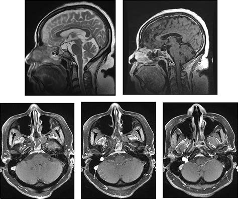 Mri Of The Head And Orbits Post Operatively Top Row Sagittal T2wi And