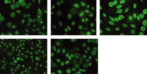 The Clinical Significance Of Antinucleolar Antibodies Journal Of