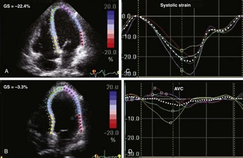 Echocardiographic Assessment of Heart Failure Resulting from Coronary ...