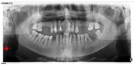 Carotid Artery Calcification Panoramic Radiograph