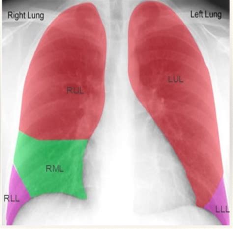 Patho Respiratory System Flashcards Quizlet