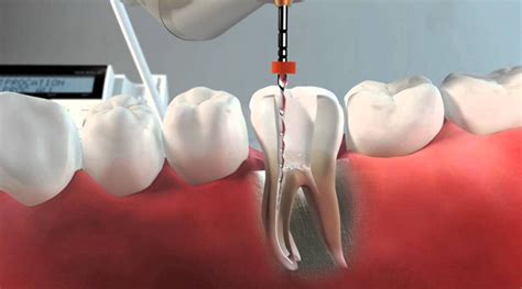 Qu Es Una Endodoncia Y Para Qu Sirve Cl Nica Dental Sevilla