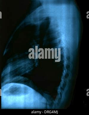 X Ray Image Healthy Chest Stock Photo Alamy