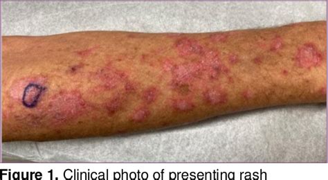 Figure 1 from Subacute Cutaneous Lupus Erythematosus Associated with ...