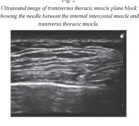 Figure 2 From The Analgesic Efficacy Of Pectoral Nerve And Transversus