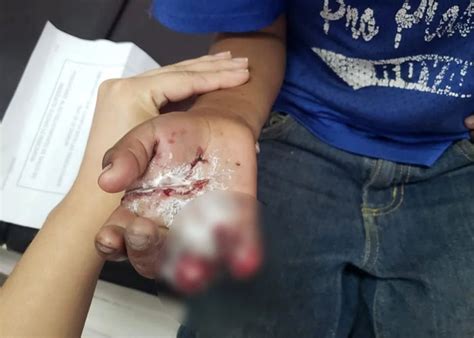 Niño pierde dos dedos al explotarle un mortero en la mano TN8 tv