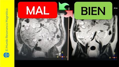 SOLUCIONADO Entero Resonancia Magnética de abdomen QUITAR RUIDO de