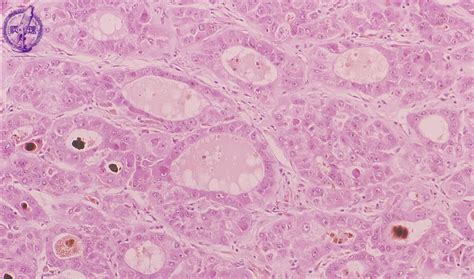 Hepatocellular Carcinoma Histology