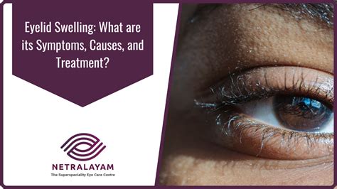 Eyelid Swelling What Are Its Symptoms Causes And Treatment Nbkomputer