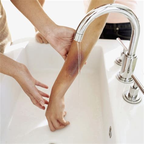 How to Care for a Bruise | Healthfully