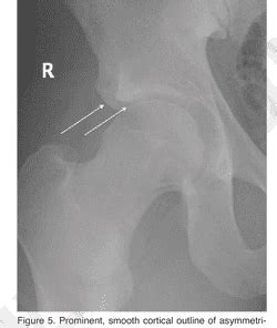 Figure From Anterior Inferior Iliac Spine Aiis And Subspine Hip