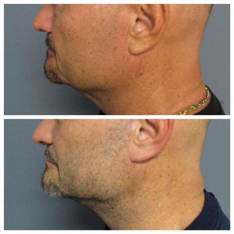 Dr Matt Goldschmidt Facelift Neck Lift Before After Photos