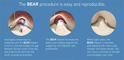 BEAR ACL Repair - Presidio Surgery Center