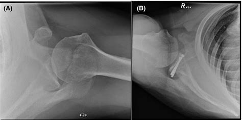 Scapula Anatomy Xray