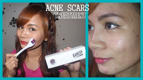 Needles On Your Face Acne Scars Treatment Using Derma Roller ♥ ♥