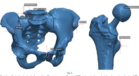 Figure 1 from Iliopsoas tendonitis after total hip arthroplasty ...