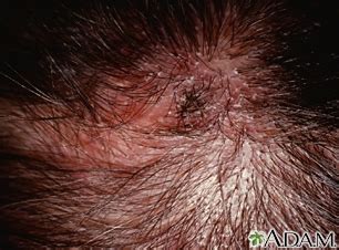 Ringworm of the scalp - UF Health