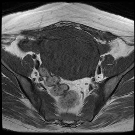 Uterine Leiomyoma With Cystic Degeneration Image