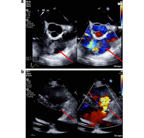 Preoperative Transesophageal Echocardiography A The Vegetation In The Download Scientific