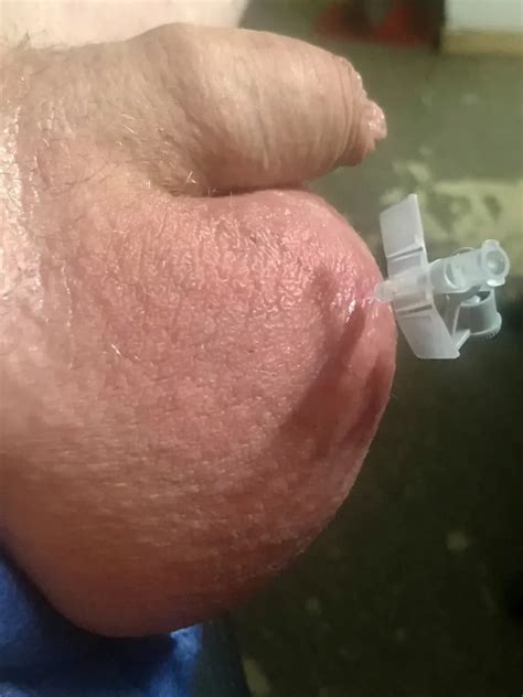 Saline Infusion Nude Pics Xhamster