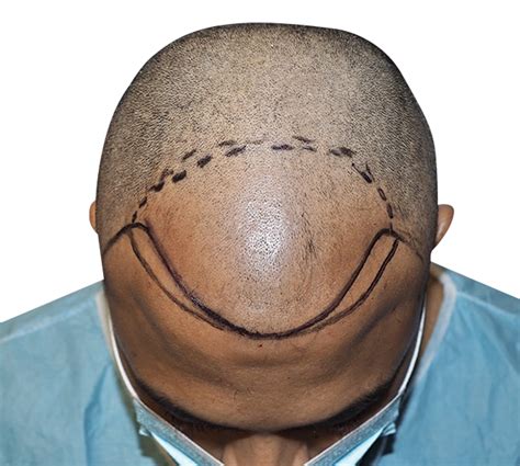 What Is A Hair Transplant The Hair Transplant Center Florida