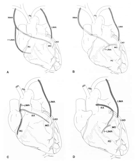 Total Arterial Myocardial Revascularization Using Five New